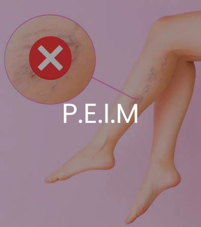 P.E.I.M também conhecido como Procedimento Estético Injetável para Microvasos.